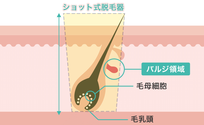 ショット式脱毛