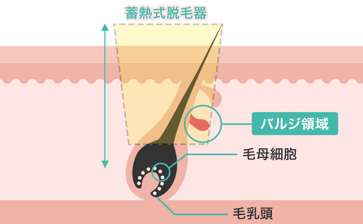 蓄熱式脱毛